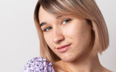 Acne: Caring for Acne-Prone Skin