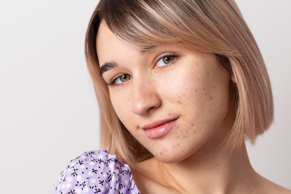 Acne: Caring for Acne-Prone Skin