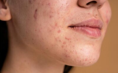 Treatment of Acne Scars in Tysons, VA | At Elite Dermatology