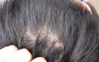 Seborrheic Dermatitis: Causes, Symptoms, and Treatment Options