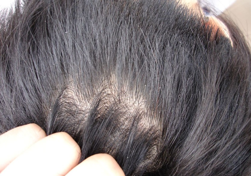 Dandruff Seborrheic dermatitis treatment Alexandria VA Elite Dermatology