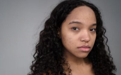 Laser Treatment for Acne Scars in Arlington VA: Why You Should Seek a Board-Certified Dermatologist