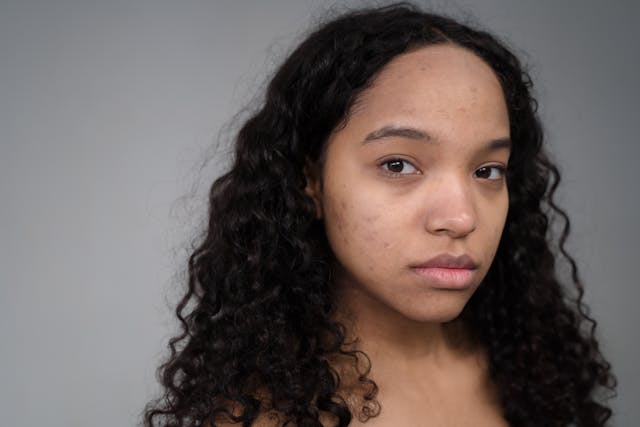 Laser treatment for acne scars Arlington Northern Virginia, acne scar laser DC