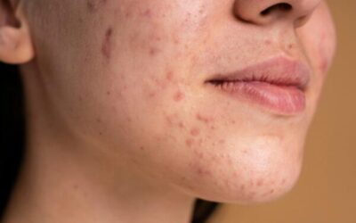Top Acne Treatments in Fairfax: Clearer Skin Starts at Elite Dermatology and Esthetics