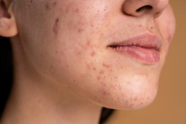 Top Acne Treatments in Fairfax at Elite Dermatology and Esthetics