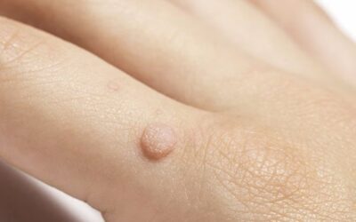 Wart Treatment: Why Seeing the Right Dermatologist Can Save You Time, Money, and Frustration