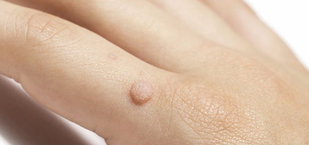 Wart Treatment Why Seeing the Right Dermatologist at Elite Dermatology Can Save You Time Money and Frustration