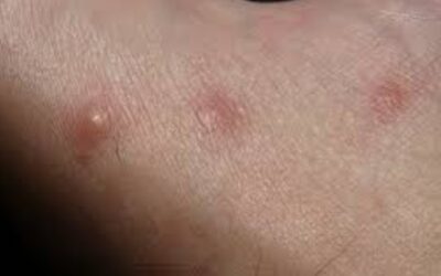 Why You Should See a Dermatologist for a Skin Rash