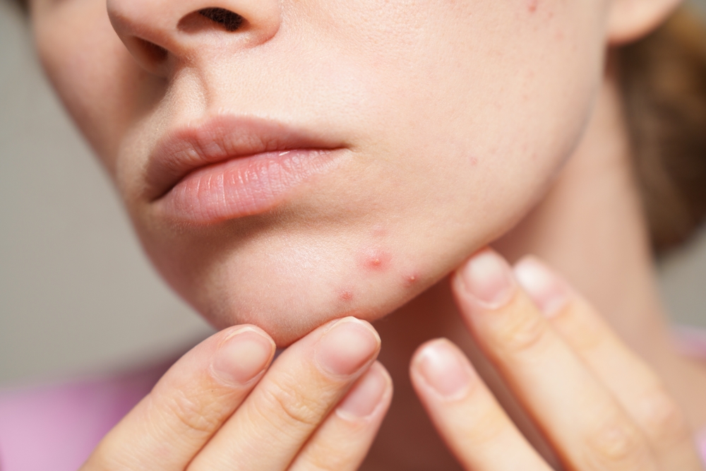 acne scar treatment fairfax