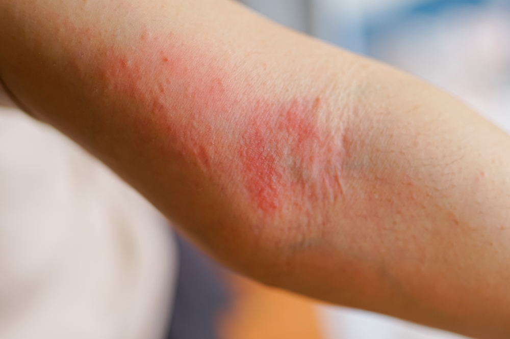 psoriasis treatment tysons va