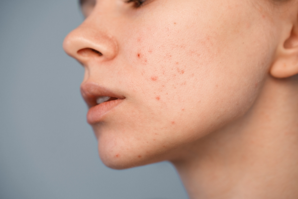 acne treatment tysons va