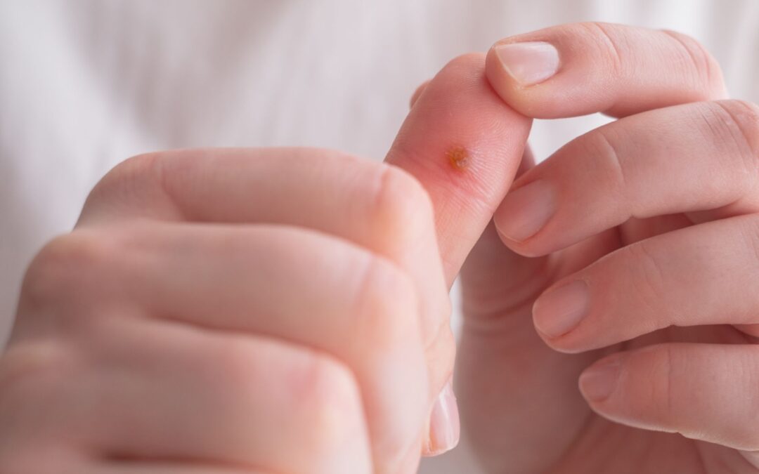 How Does a Dermatologist Remove a Wart?