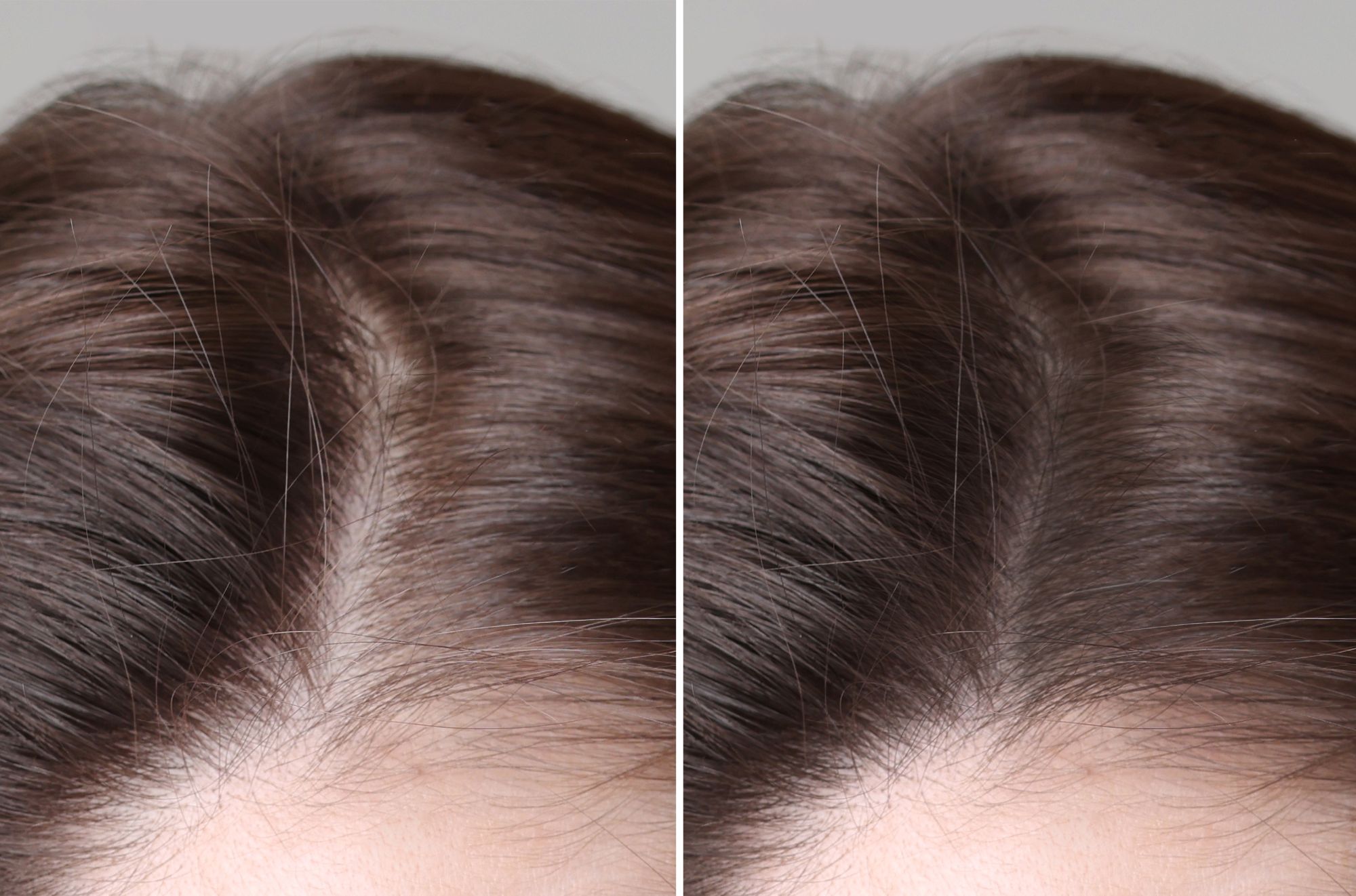 Hair Regrowth Treatment