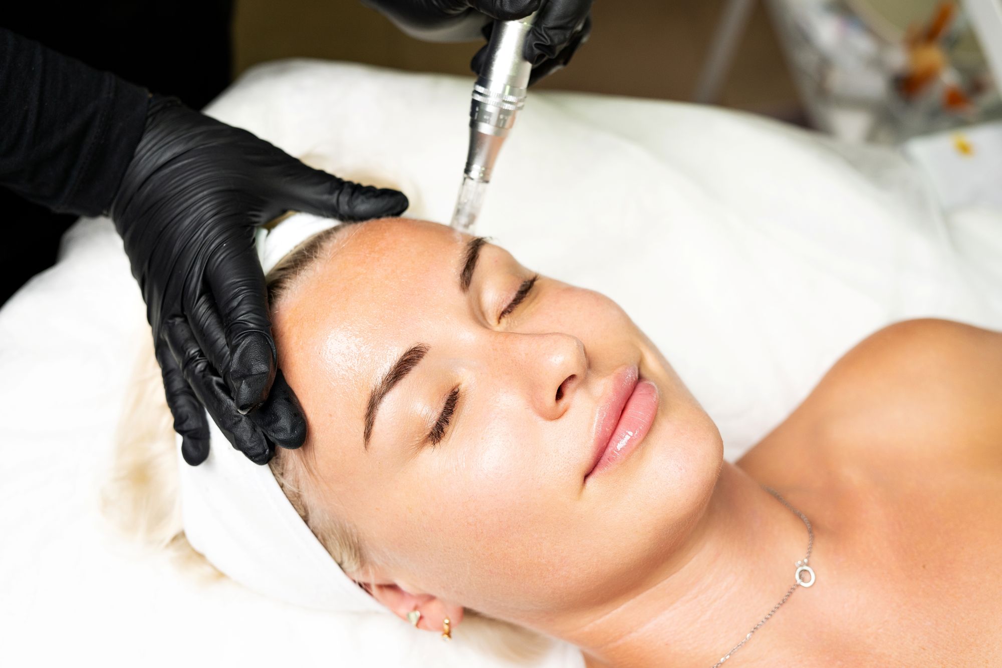 Microneedling Treatments