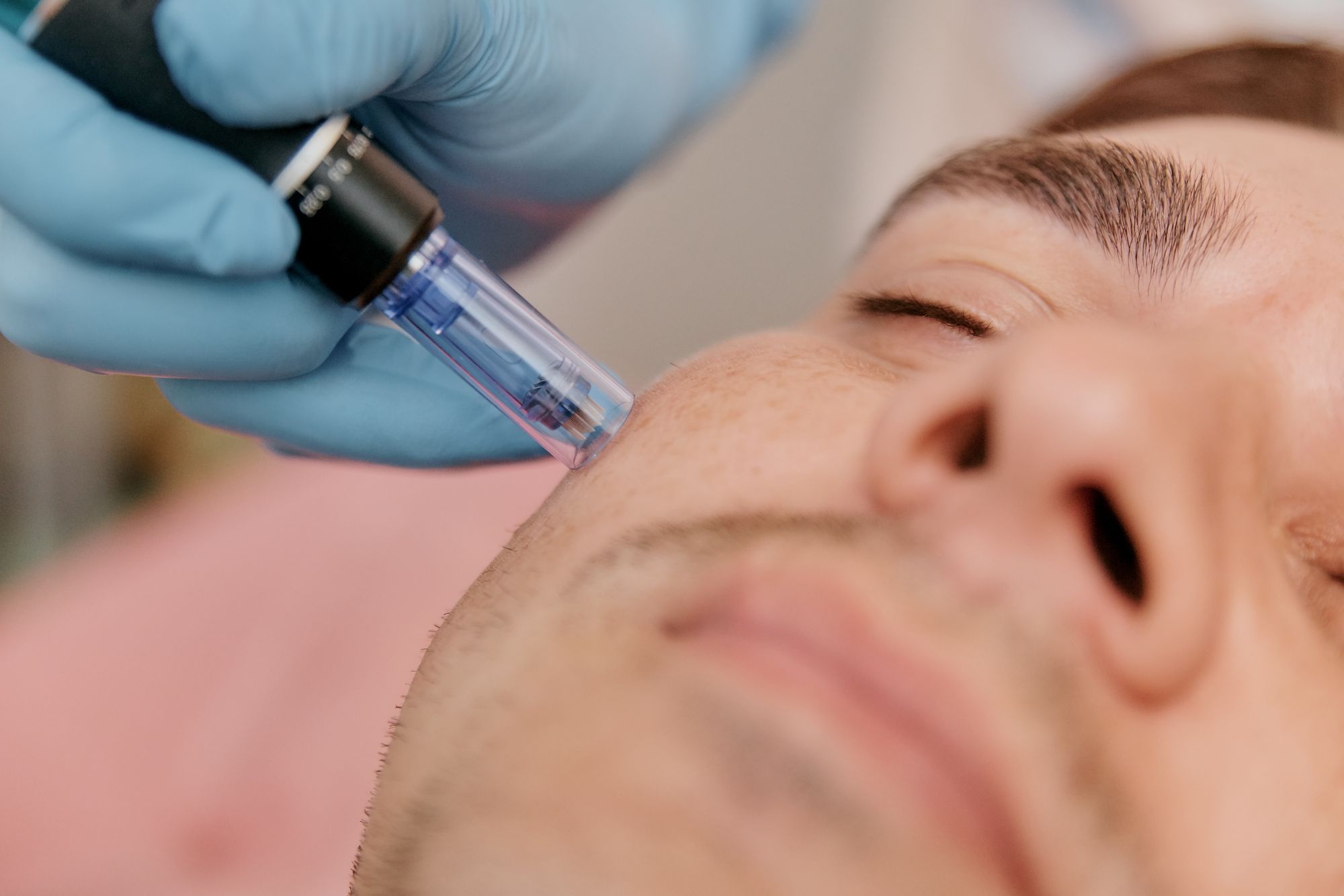 Microneedling in Tysons