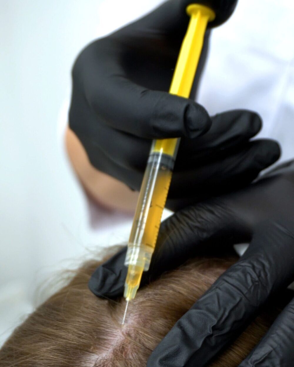 PRP Scalp Injections