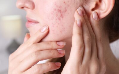 Best Treatments for Acne Scars: Professional Clinical Solutions