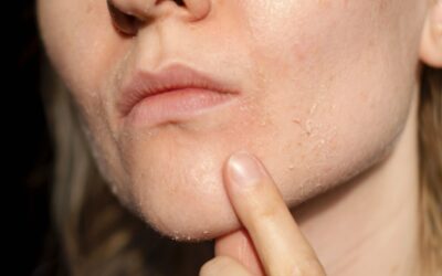 Why Your Skin Is Dry in the Summer And How We Treat It