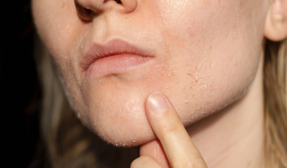 Why Your Skin Is Dry in the Summer And How We Treat It